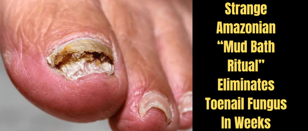 Strange Amazonian Mud Bath Ritual Eliminates Toenail Fungus In Weeks